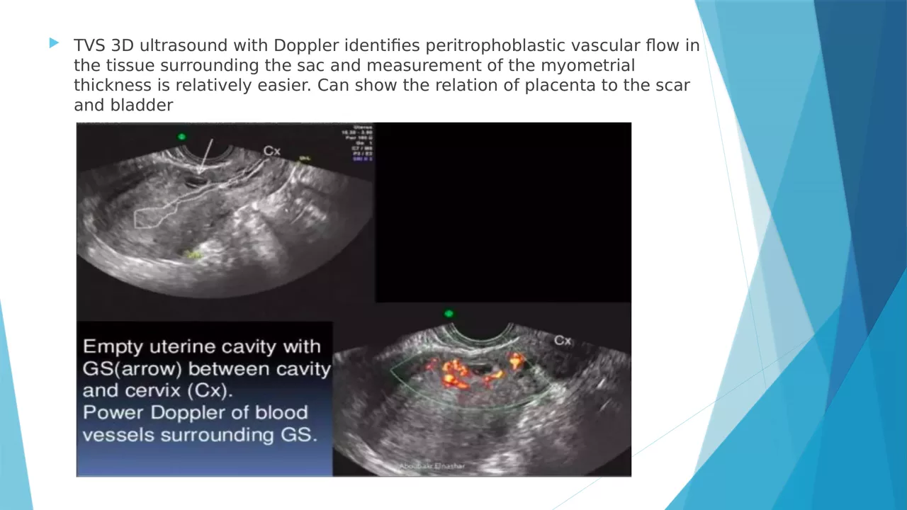 Frame from the narrated Caesarean Scar Ectopic training video showing an ultrasound imaging slide